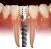 Dental Implants: Pros and Cons